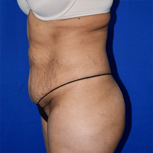 Abdominoplasty