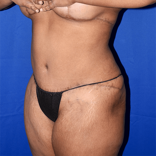 Abdominoplasty