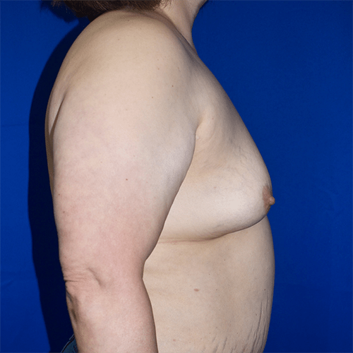 Breast Augmentation