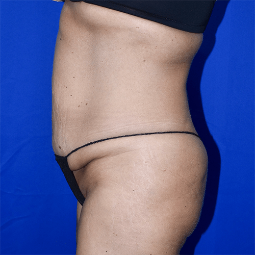 Abdominoplasty