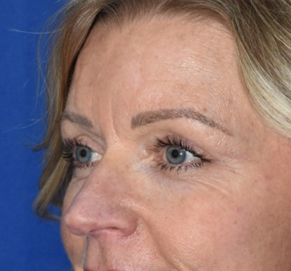 Eyelid Surgery