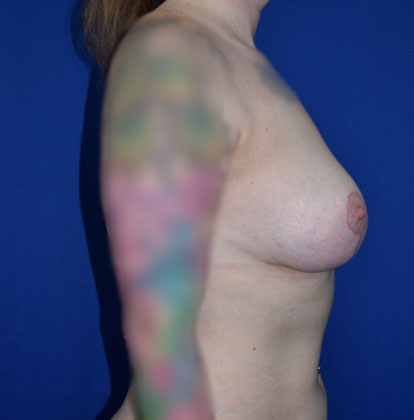 Breast Lift