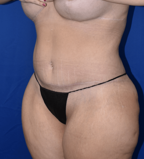 Abdominoplasty