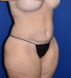 Abdominoplasty