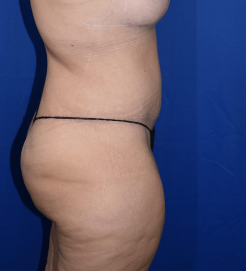 Abdominoplasty