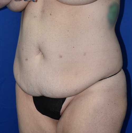 Abdominoplasty