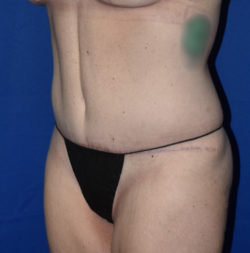 Abdominoplasty