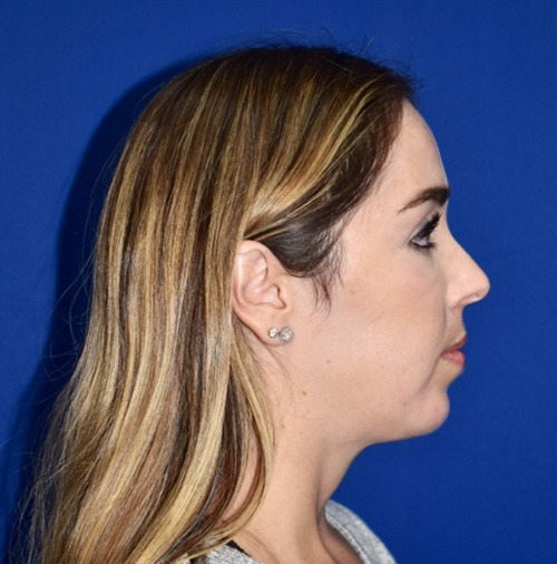 Chin Liposuction