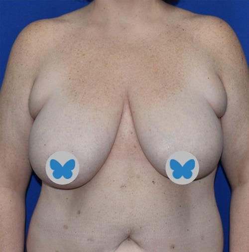 Breast Lift