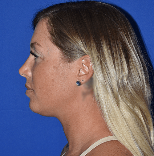 Chin Liposuction