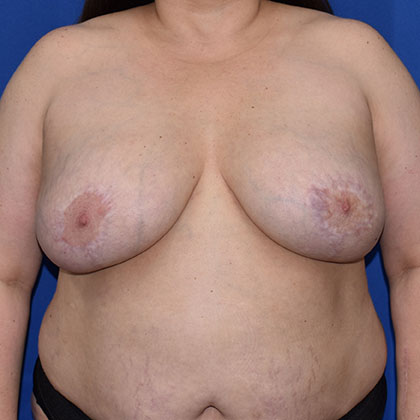 Breast Implant Removal