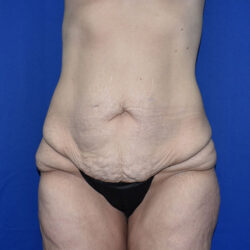 Abdominoplasty