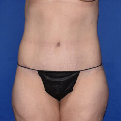 Abdominoplasty