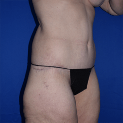 Abdominoplasty