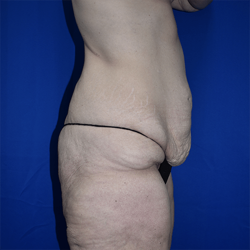 Abdominoplasty