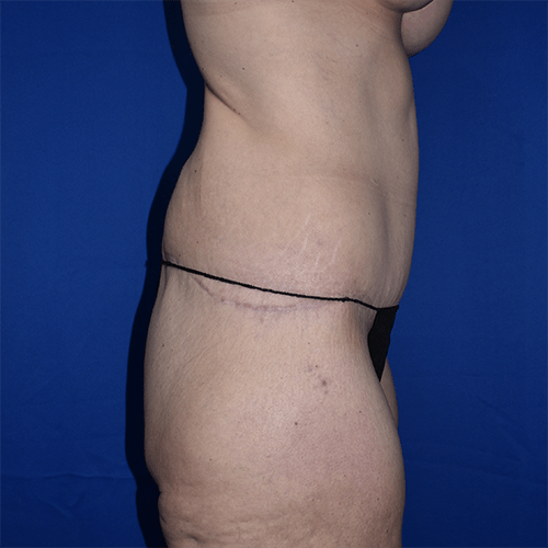 Abdominoplasty