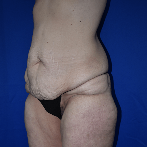 Abdominoplasty