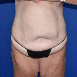 Abdominoplasty