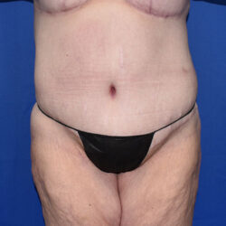 Abdominoplasty