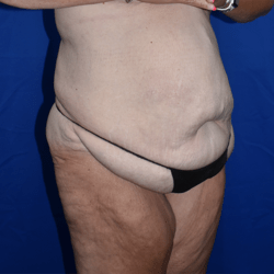 Abdominoplasty