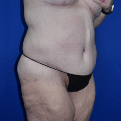 Abdominoplasty