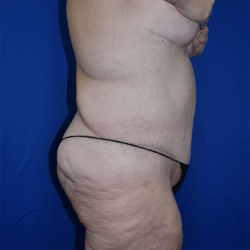 Abdominoplasty