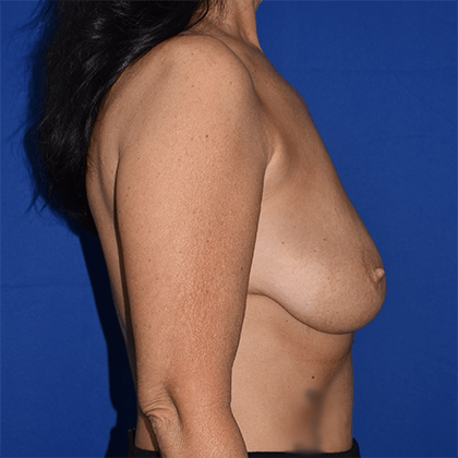 Breast Implant Removal