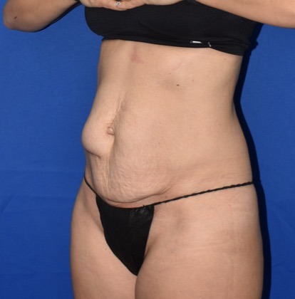 Abdominoplasty