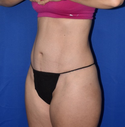 Abdominoplasty