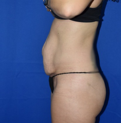 Abdominoplasty