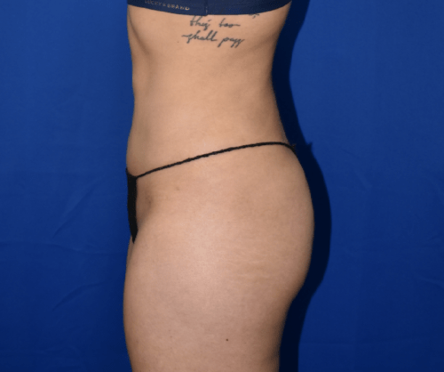 Liposuction