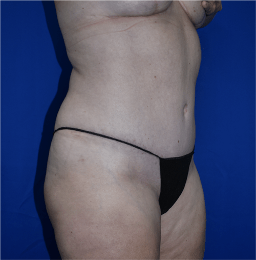 Abdominoplasty