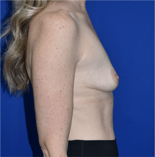 Breast Augmentation With Lift