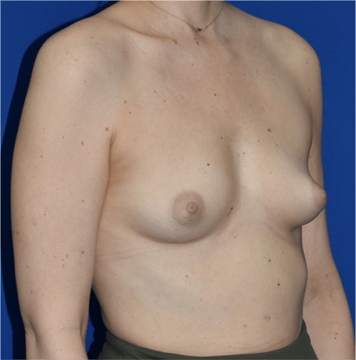 Breast Augmentation