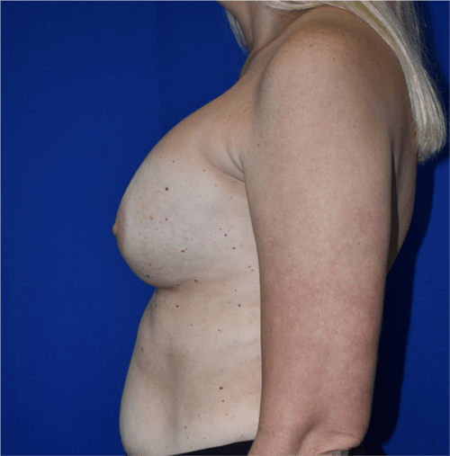 Breast Implant Revision