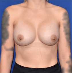 Breast Augmentation