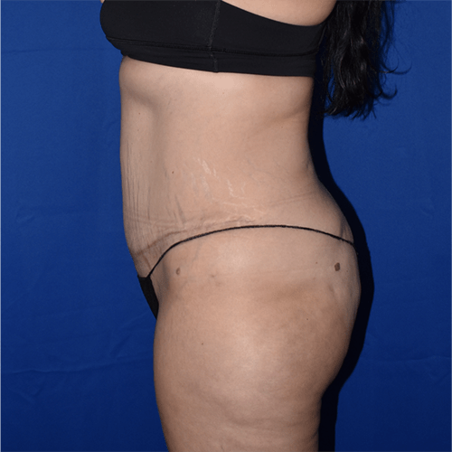 Abdominoplasty