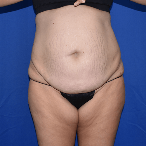 Abdominoplasty