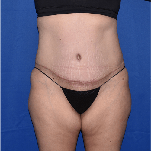 Abdominoplasty