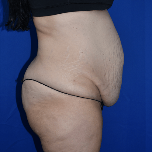 Abdominoplasty