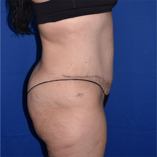 Abdominoplasty