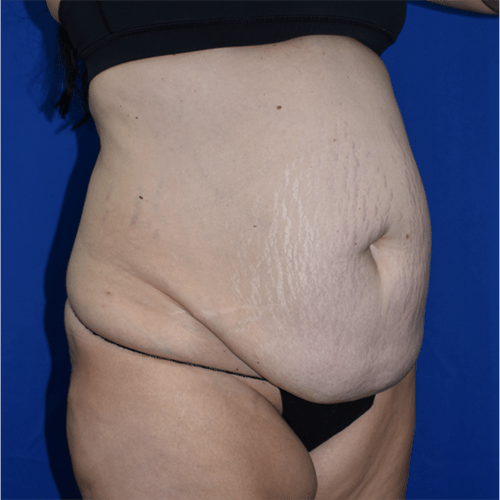 Abdominoplasty