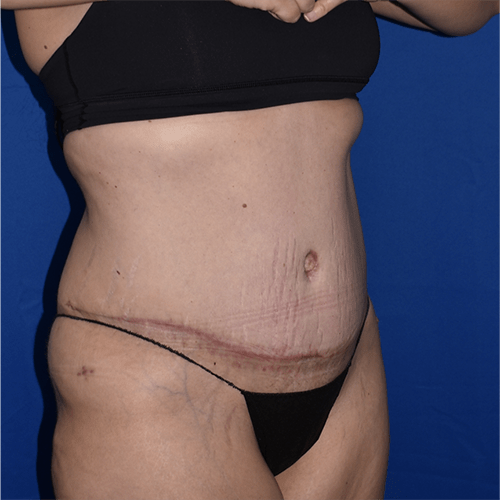 Abdominoplasty