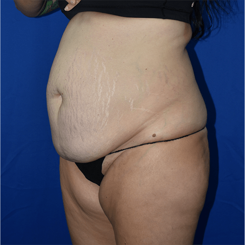 Abdominoplasty