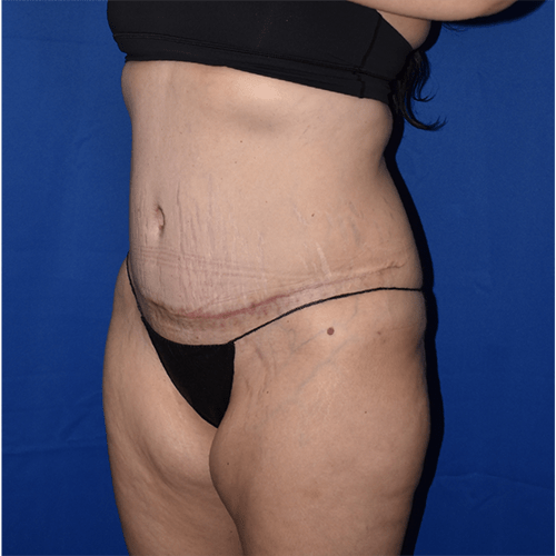 Abdominoplasty