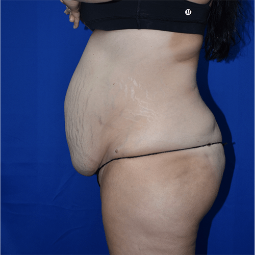 Abdominoplasty