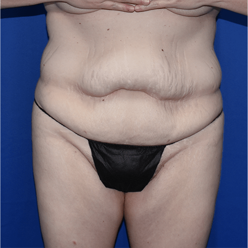 Abdominoplasty