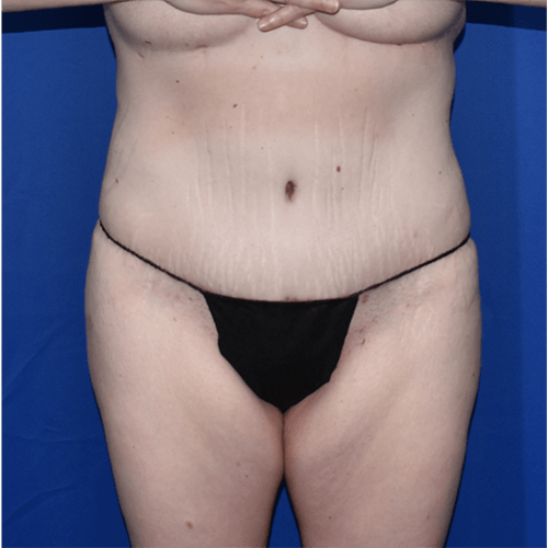 Abdominoplasty