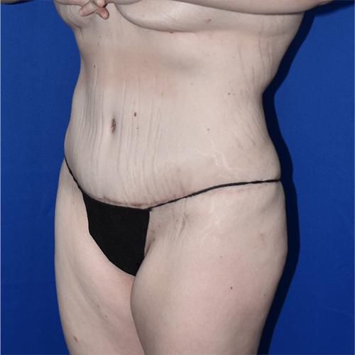 Abdominoplasty