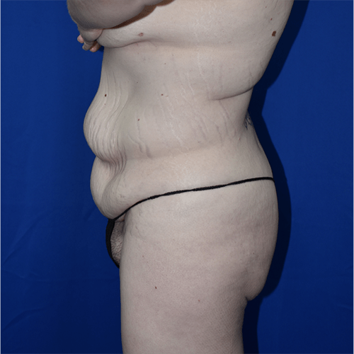 Abdominoplasty